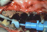 Severe (stageV) Periodontal Disease