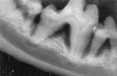 Xray Stage V Adult Periodontitis